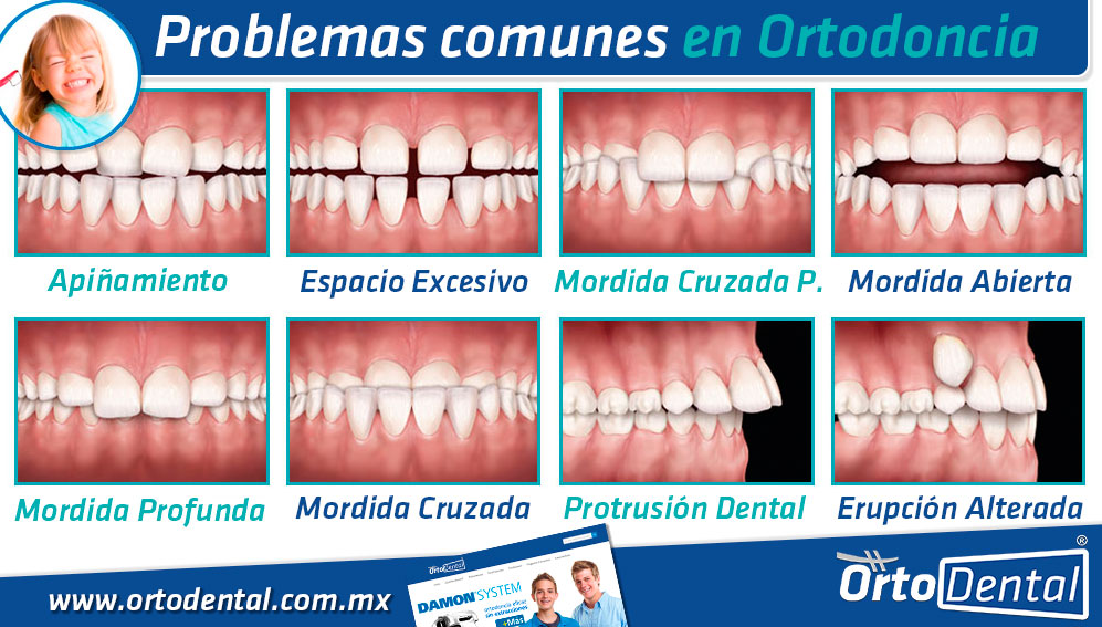 Problemas en Ortodoncia Dientes