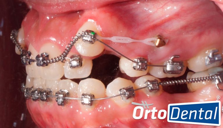 Retraccion De Canino Alto Con Mini Implantes Ortodoncia OrtoDental