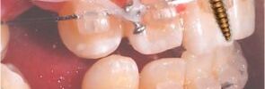 ¿Qué son los mini-implantes de ortodoncia? Conoce sus cuidados