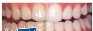 ¡Descubre el Poder del Blanqueamiento Dental Láser con Laserwhite 2.0 de BIOLASE en OrtoDental!