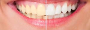 ¡Descubre el Poder del Blanqueamiento Dental Láser en OrtoDental!