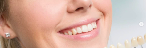 Mitos y Realidades del Blanqueamiento Dental Láser
