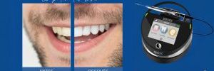 El Blanqueamiento Dental Láser - Sonrisa Radiante y Confianza Renovada
