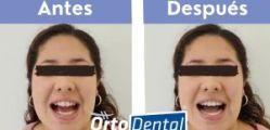 Invisalign In-Face Visualization: Visualiza tu Nueva Sonrisa Antes de Comenzar tu Tratamiento