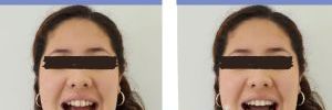 Invisalign In-Face Visualization: Visualiza tu Nueva Sonrisa Antes de Comenzar tu Tratamiento