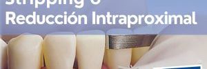 ¿Que es el Stripping o Reduccion Interproximal en Ortodoncia y para que Sirve?