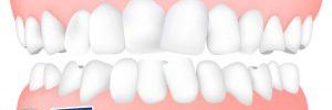 Las Maloclusiones Dentales Ocupan el Tercer Lugar de Problemas Dentales