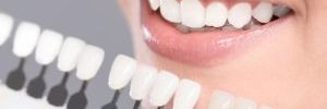 Blanqueamiento Dental y Ortodoncia: La Clave para una Sonrisa Perfecta