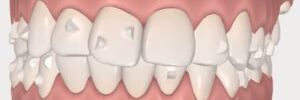 Conoce el Protocolo Invisalign G6 de Extracciones