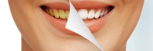 Blanqueamiento Dental, lo que necesitas saber