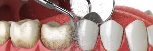 Limpieza Dental: ¿cuándo hacerla?
