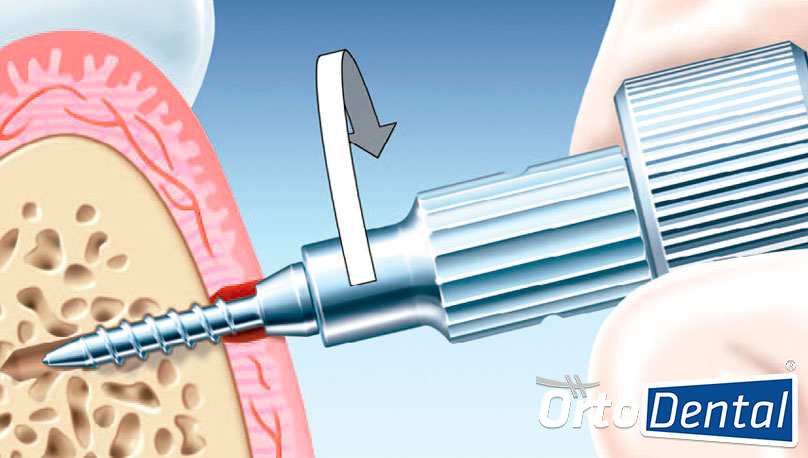 Insercion de Implante en Ortodoncia