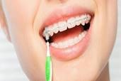 limpieza-dental