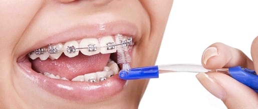 deshonesto fragancia Necesario Cepillado e Higiene Dental durante la Ortodoncia | OrtoDental |  Ortodoncista en México DF CDMX