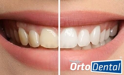 Blanqueamiento Dental, ¿Cuál y Cada Cuánto? | OrtoDental | Ortodoncista en  México DF CDMX