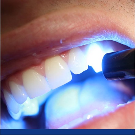 Qué es y para qué sirve la resina dental?