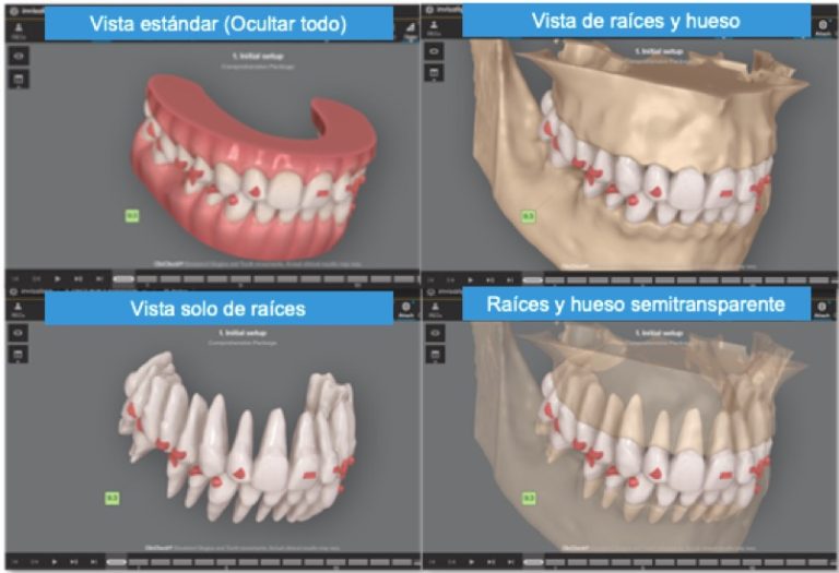 Nueva Tomografía Computarizada De Haz Cónico Cbct De Invisalign