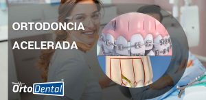 Ortodoncia Acelerada