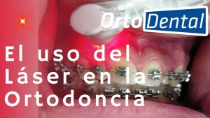Láser Terapéutico en Ortodoncia
