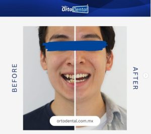 Invisalign en México