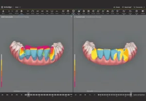 Smile Architect Invisalign 