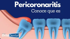 Pericoronaritis