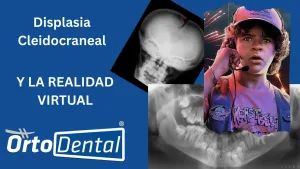 Displasia Cleidocraneal