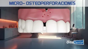 micro-osteoperforaciones