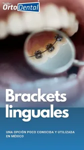 ortodoncia lingual