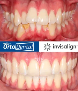 Caso Apiñamiento Severo CII Enero 2026 1