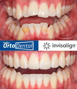 Caso Apiñamiento Severo CII Enero 2026 2