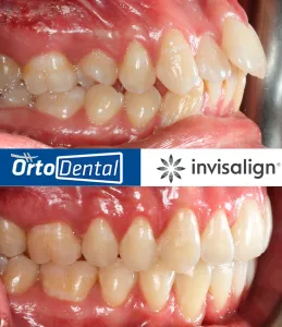 Caso Apiñamiento Severo CII Enero 2026 3