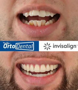 Caso Apiñamiento Severo CII Enero 2026 4