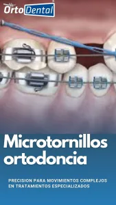 Microtornillos de ortodoncia