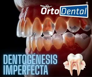 dentogénesis imperfecta 
